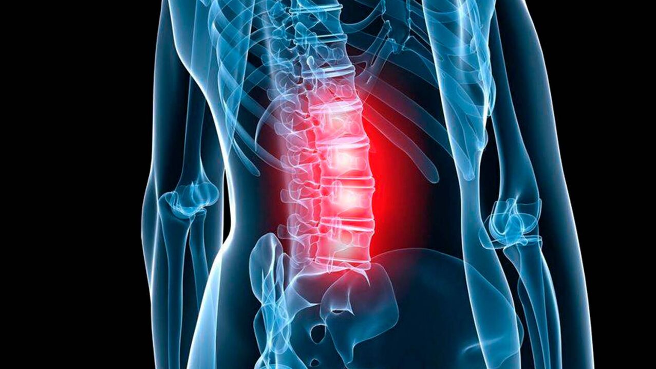 juosmens osteochondrozės simptomai