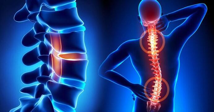 Skausmo lokalizacija sergant osteochondroze
